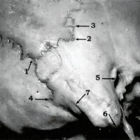 Fig. 3. Reparos óseos para estudiar el ángulo de unión. 