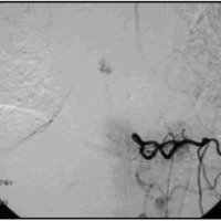 Fig. 2. Angiografía digital: lesión tumoral vascularizada nivel D6.