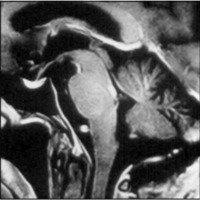 Fig. 6. Caso 2. IRM postoperatoria: resección completa de la malformación.