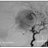 Fig. 2. Angiografía cerebral de la arteria carótida izquierda en incidencia oblicua, que evidencia una MAG tipo coroide