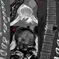 Figura 5: Paciente masculino de 60 años, con diagnóstico de mielopatía dorsal residual, operado en 4 oportunidades por vía posterior. Obsérvese a la izquierda la hernia de disco calcificada central (a-b-c-d) y a la derecha la descompresión amplia que se obtiene me-diante este abordaje (e-f-g). Las mioclonías y clonus desaparecieron a los 5 dias post-operatorios pasando de un McCormick IV a un McCormick II a los 6 meses posteriores a la cirugía.
