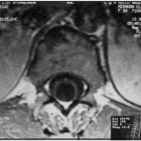 Fig. 2. Imágenes prequirúrgicas, diciembre de 2003. (IRM corte axiales)