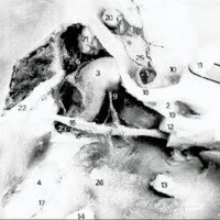 Fig. 4. Vista lateral del seno cavernoso luego de retirado el contenido de su pared lateral, clinoides anterior, clinoides posterior, techo de canal óptico y órbita.