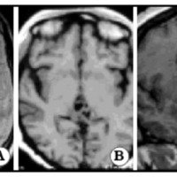 Fig. 1. Localización de los tumores: A. Lesión ventricular derecha. B 3er. ventrículo posterior. C Septotrigonal.