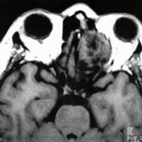 Fig. 2. IRM axial que muestra una tumoración hipointensa.