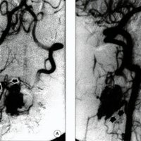 Fig. 2. Angiografía vertebral derecha. Incidenciafrente (A) y perfil derecho (B), donde se visualizan las aferencias por arterias radiículomedulares y el nido arigiomatoso.