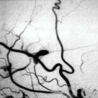 Fig. 2. Imagen postoperatoria. La flecha indica la anastomosis