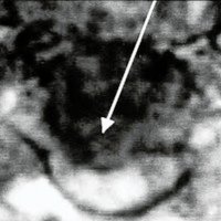 Fig. 6. AC: osteofitosis láteromedial