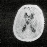 Figura 6. TAC postoperatoria a las 72 hs. que muestra la expansión cerebral y un muy reducido contenido aéreo.