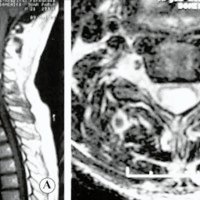 Fig. 3. IRM de columna cervical. A. Se observa lesión quística intramedular hipointensa en T1 en sectorC3-C6 con nódulo mural que refuerza con gadolinio. B. Lesión hiperintensa intramedular en sector posterolateral dela médula espinal, ubicación de preferencia de los hemangioblastomas medulares.