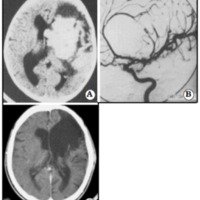 Figura 2. A. IRM prequirúrgica en un cavernoma gigante frontal izquierdo. B. angiografía prequirúrgica. C. IRM postquirúrgica.