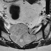 Figura 1: A,B) Representan cortes sagitales en secuencia T2 y T1 de RMN que muestran respectivamente la lesión tumoral osteólitica a nivel S2-S4. C)  MieloRMN que evidencia la obstrucción a la circulación de LCR. D,E) Secuencias axiales tumorales en T2 muestran relación de la superficie tumoral anterior con el retroperitoneo. F) Representa un corte axial tomográfico en donde se visualiza la extensa osteólisis y remodelación sacra.
