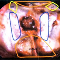 Fig. 6. Reparos anatómicos dentro del seno esfenoidal, puede observarse en la parte superior y anterior en naranja el plano esfenoidal (PE), la prominencia de ambos nervios ópticos en amarillo (NO), la de ambos senos cavernosos a los lados de la silla turca en azul (SC), la región medial del clivus en la parte posterior y en naranja y la silla turca abierta (ST)