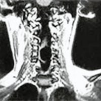Fig. 3. A y B, IRM en TI de la médula cervical, cortes sagital y coronas: lesión quistica ovoidea, bien delimitada, desde C5 a C7, en situación ventral a la médula e hipointensa en relación a la misma. C. Corte axial en C6: médula espinal severamente aplanada en forma de cinta y posterior a la formación quística.