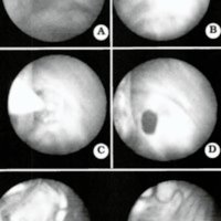 Fig. 2. A. Endoscopic photograph showing the cerebellar hemispheres and inferior border of the cyst. B. Bipolar coagulation of the inferior wall of the cyst. C. Balloon dilatation of the fenestration. D. Fenestration of the inferior cyst wall (cysto-cisternostomy). E. Visualization of the lower cranial nerves and the spinal cord by the rigid neuroendoscope.