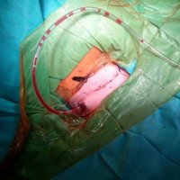 Figura 23: Se observa sutura intradérmica y drenaje para evitar hematoma sofocante.