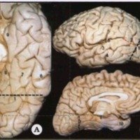 Esclerosis temporal mesial: Paradigma de la epilepsia de resolución quirúrgica 