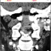 Fig. 11. Estabilización craneocervical luego de un abordaje transcondilar. A. Esquema. B. TAC: corte coronal. C. Imagen quirúrgica.