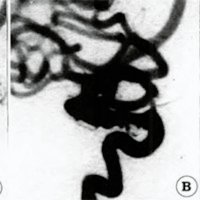 Fig 9. Caso N° 21. A. Angiografia en incidencia lateral de aneurisma caroiídeo inferior de cuello amplio. B. Oclusión inmediata subtotal por no aceptar más endoprótesis en el interior. C. Angiografía de control a un año muestra oclusión completa.