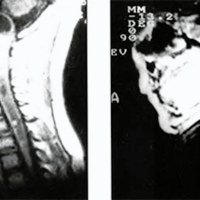 Fig. 3 A. Otro caso. Tumor bulbomedular sólido. RNM T1. B. Exéresis parcial del tumor.