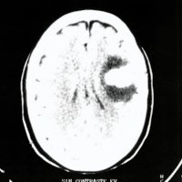 Fig. 1. TAC que muestra una lesión espontáneamente hiperdensa
