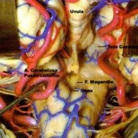 Fig. 7. Arteria cerebelosa posteroinfertor y su relatión con la fisura cerebelobulbar.<br />
