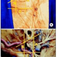 Estudio Anatómico de los Pares XII y VII Extracraneanos en la Anastomosis Hipogloso-Facial