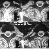 Fig. 3. B. IRM axiales (B) que muestran AEE anterior cervicotoracolumbar.