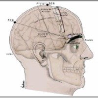 Planeamiento neuroquirúrgico informático: resultados con su utilización
