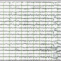 Fig. 10. EEG de SCALP que muestra el inicio de una crisis temporal.