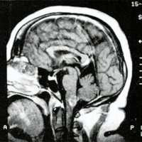 Fig. 1. IRM sagital preoperatoria. Cavernoma de cara posterior y pial del bulbo.