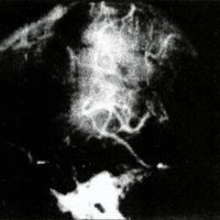 Fig. 4. Angiografia carotídea: trombosis en la confluencia seno recto-seno longtudinal inferior,