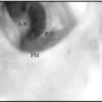 Fig. 2. Durante la inspección de un paciente donde fracasó una tercer ventriculostomía se constata la persistencia del ostoma, por lo que se considera que el paciente es incapaz de reabsorber LCR y se indica la colocación de un shunt.. F.M.: Foramen de Monro. P.V.: Piso Ventricular (III). A. B.: Arteria Basilar