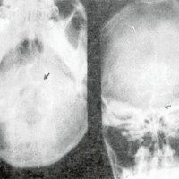Figura 3. Caso 7. Arteriografía vertebral en dos incidencias A.P.