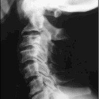 Subluxación atlanto-axial anterior secundaria a osteoartritis: reporte de un caso