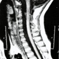 Fig. 4. IRM de control que muestra una cavidad siringomielítica residual.