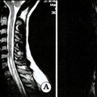 Fig. 3. IRM en T2 de columna cervical y dorsal de la paciente.